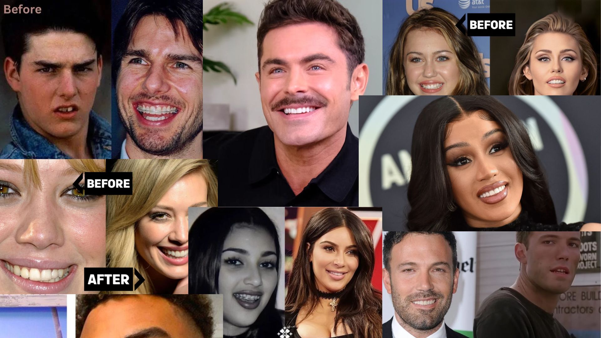 Celebrities With Veneers